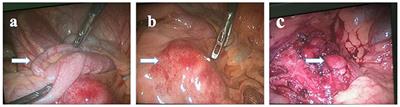 Histiocytic Necrotizing Lymphadenitis Mimicking Acute Appendicitis in a Child: A Case Report